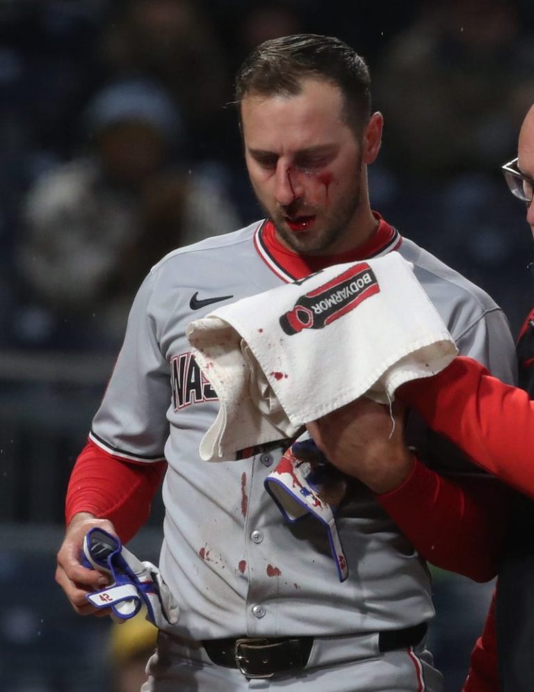 Drilled in face with pitch, MLB All-Star begins road back to baseball